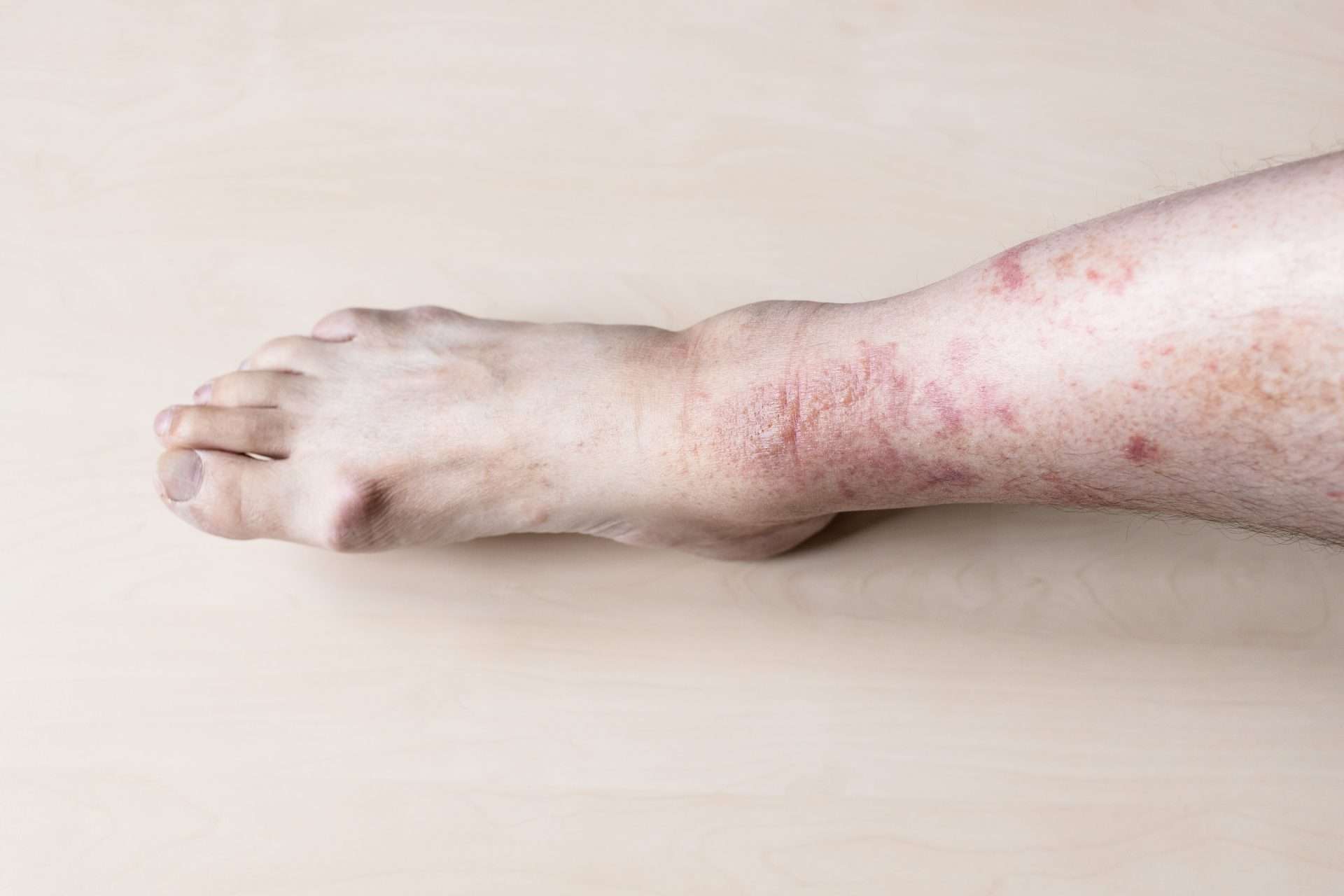 Poison ivy rash on skin
