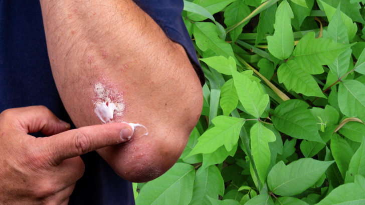Encounters With Poison Ivy in the Outdoors: Best and Fastest Remedies